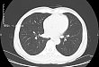 做 CT 时憋没憋气能看出来吗？