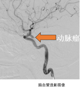 误以为的颈椎病，竟险些引爆「 定时炸弹」