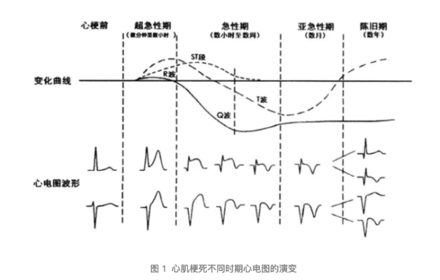 siqiiitiii心电图表现图片