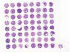 食道癌及淋巴结转移癌组织芯片DM065Es01