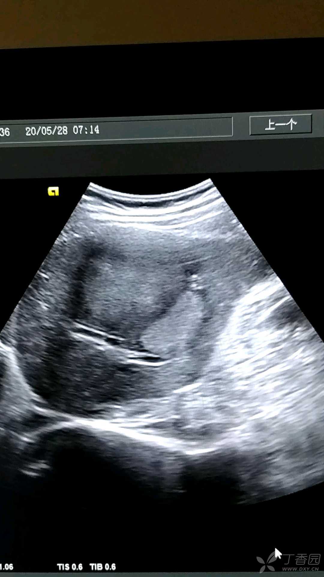 肝内占位性病变原发性肝癌