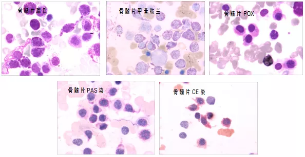常与急性白血病混淆的罕见病，有什么特异性表现？