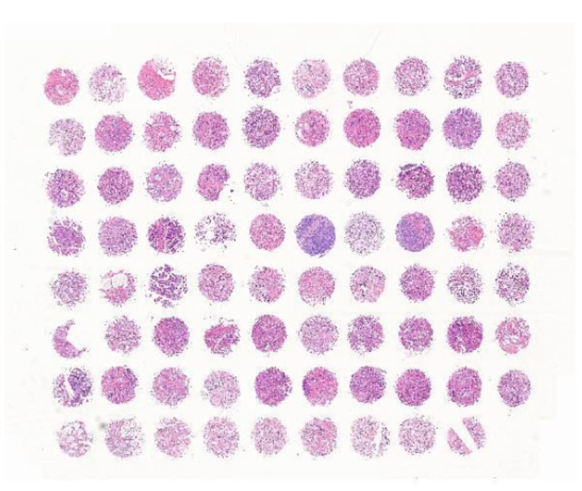 前列腺癌组织芯片，附WHO病理分级分组、Gleason评分 M079Pr01
