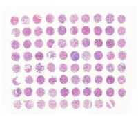 前列腺癌组织芯片，附WHO病理分级分组、Gleason评分 M079Pr01