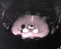 脑出血—胶原酶造模