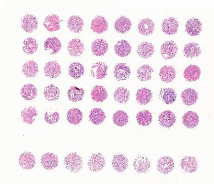 前列腺癌組織芯片，附WHO病理分級分組、Gleason評分 M048Pr01