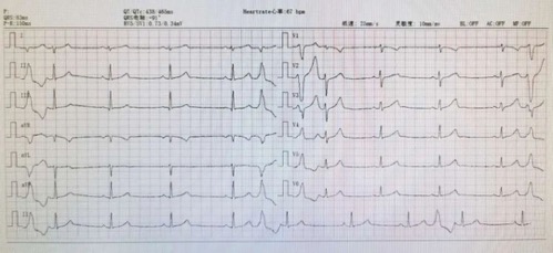 治疗频发室性早博 和睦家心血管中心又有 新武器 医院汇 丁香园