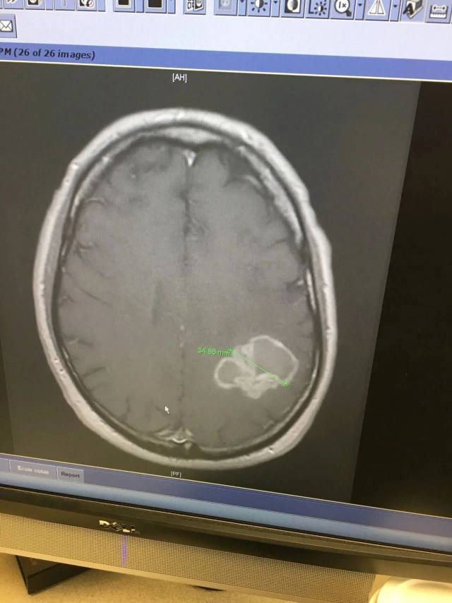Carpenter 的脑肿瘤图像.jpeg