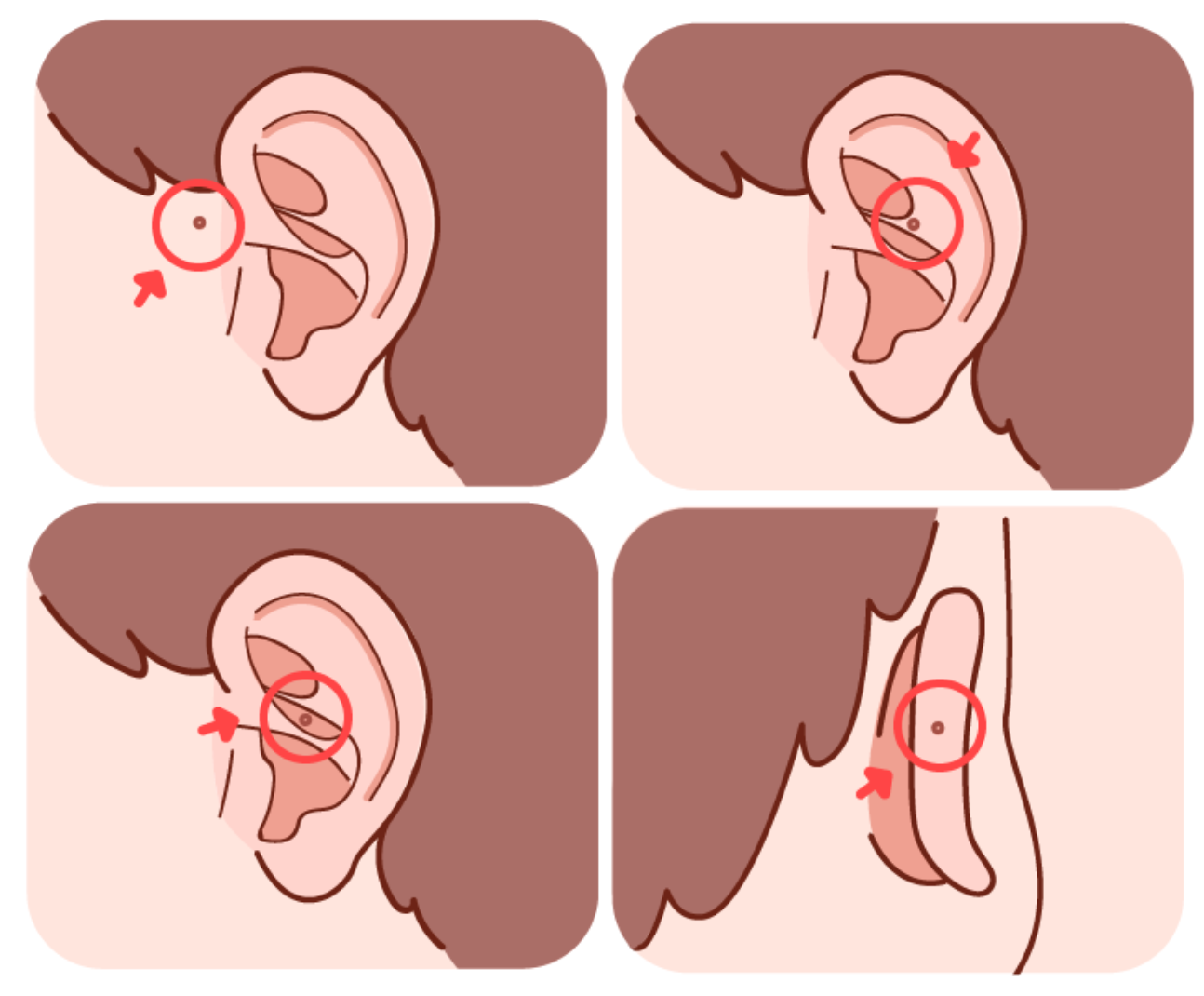 耳前瘘管症状