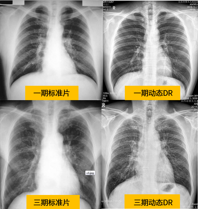 早期尘肺胸片图图片