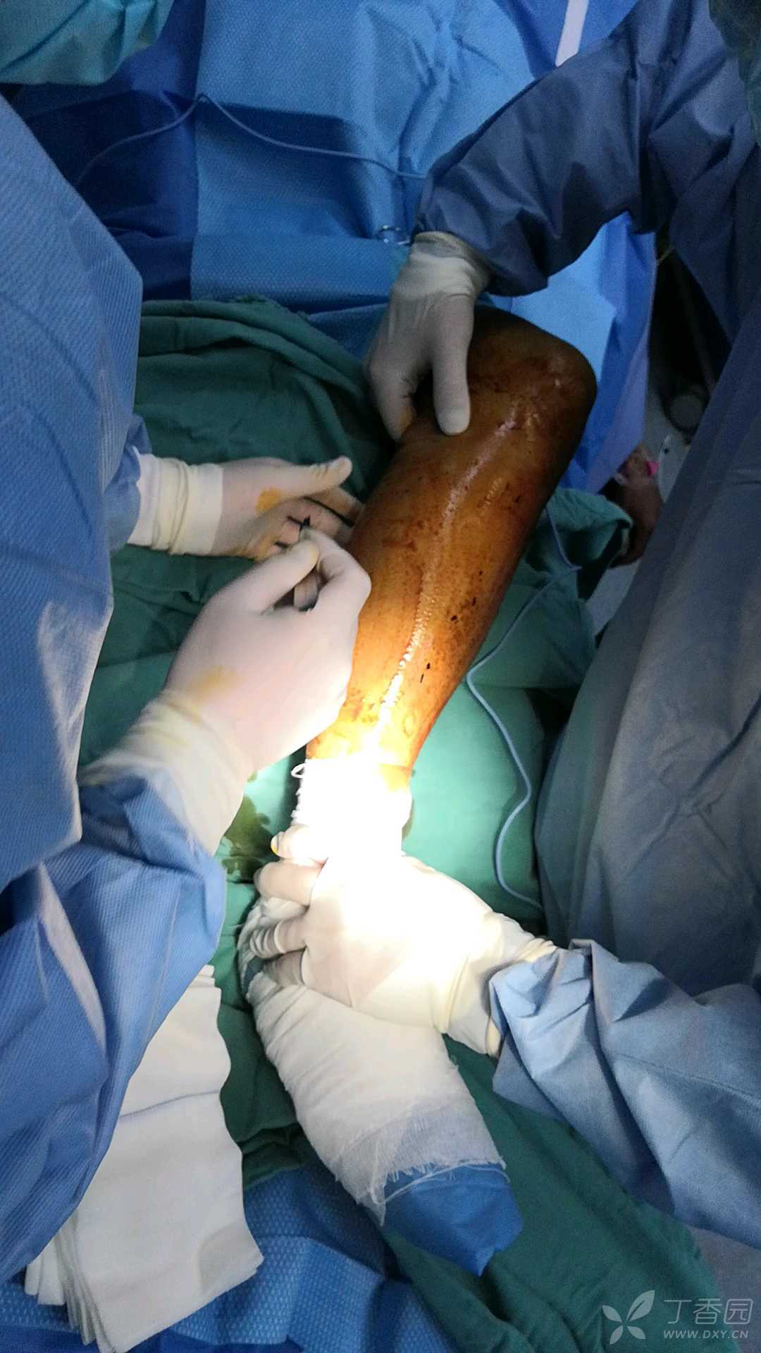 小腿骨筋膜室切开位置图片
