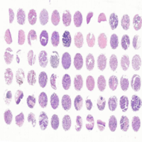 多器官肿瘤和匹配瘤旁组织组合芯片X72Mc01