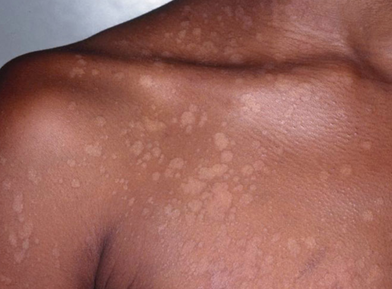 真菌性感染皮肤病有多难治？ - 知乎