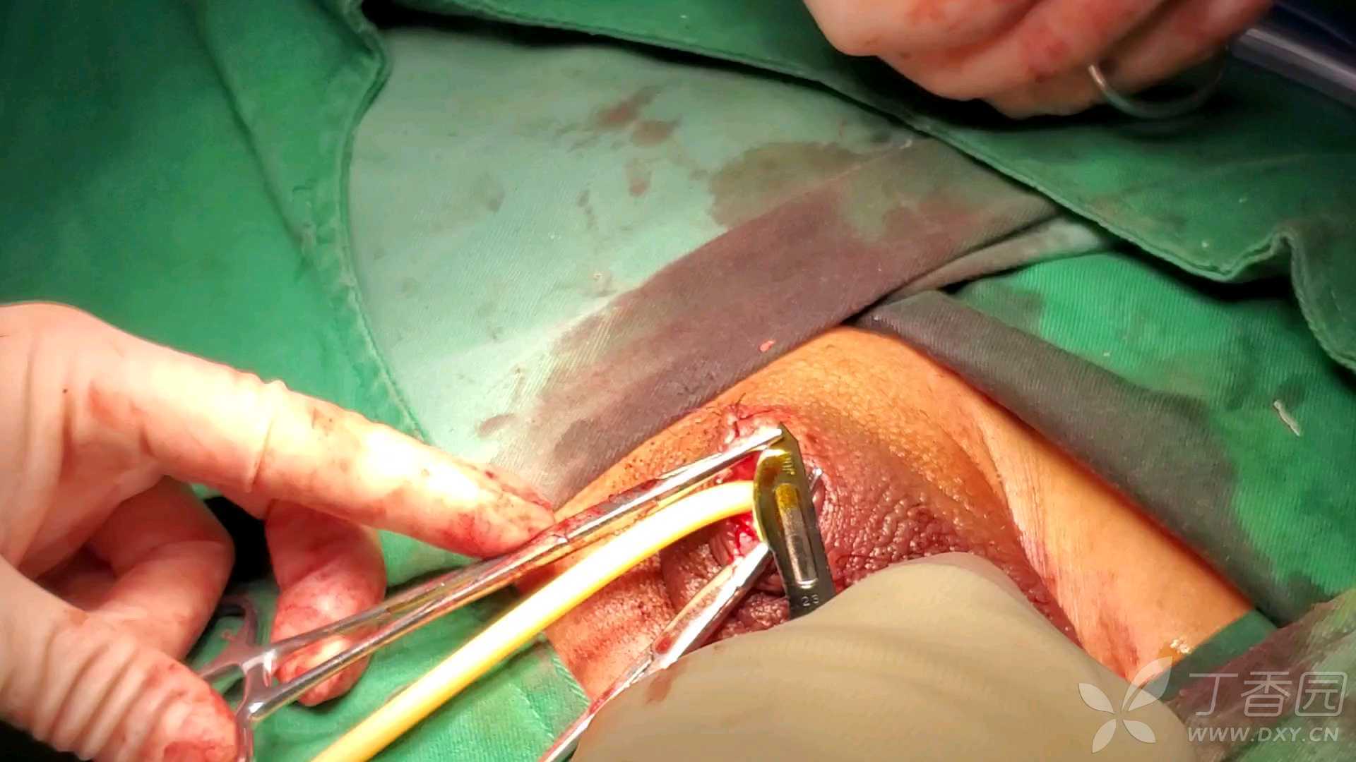女性膀胱手术切开图片