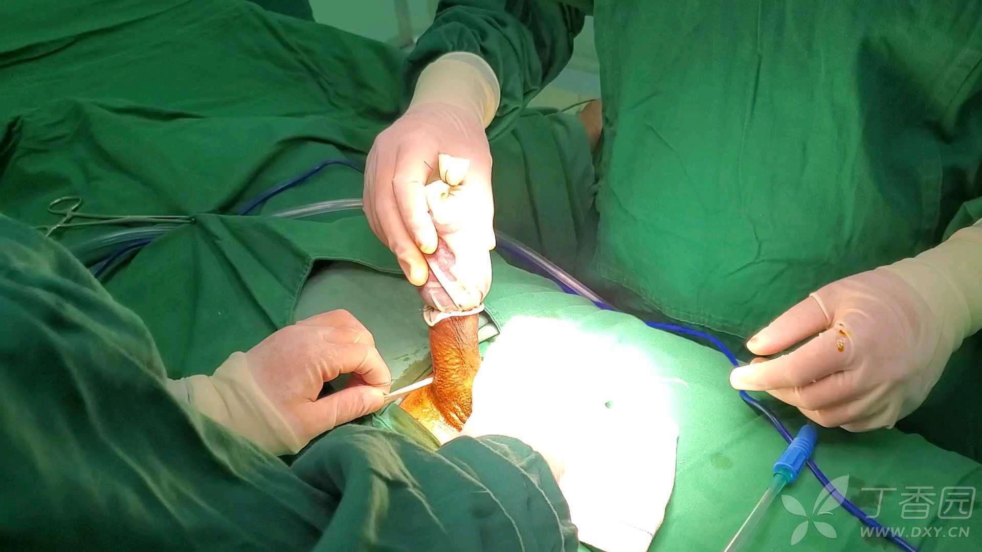 男性假体手术图片图片