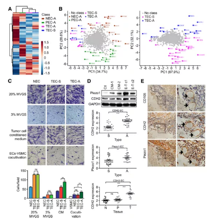 Molecular Cancer：蛋白质组学联合多种分子检测技术揭示CDH2以促进血管生成的方式促进肺腺癌的发生发展