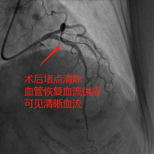 梅雨季与冠心病的「不解之缘」