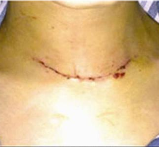 传统常规甲状腺手术后颈部疤痕.png