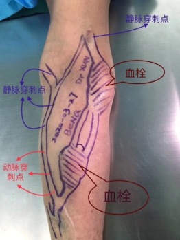 苏州明基医院一张血管手绘照片火了朋友圈的背后······