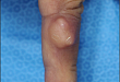今日病例：手指低级别纤维黏液样肉瘤 1 例