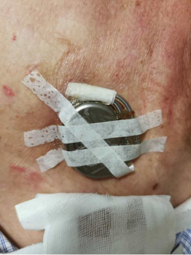 安装起搏器伤口图片图片