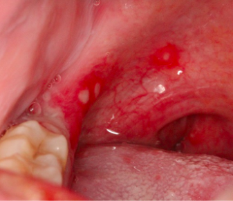 口腔溃疡照片症状图片