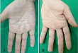 掌部水源性皱褶：极易被忽视的疾病