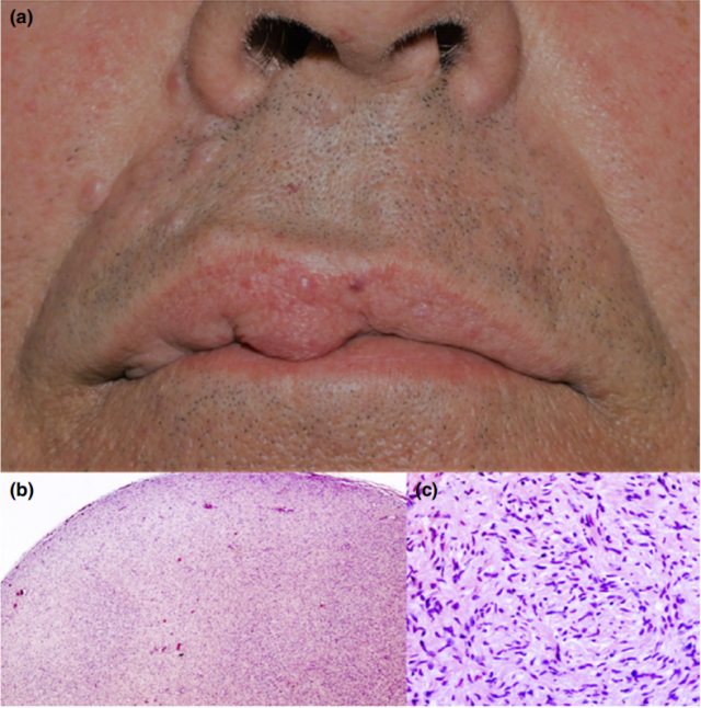 (a)右上唇多个结节,丘疹(b,c)组织病理学可见真皮团块状增生的梭形