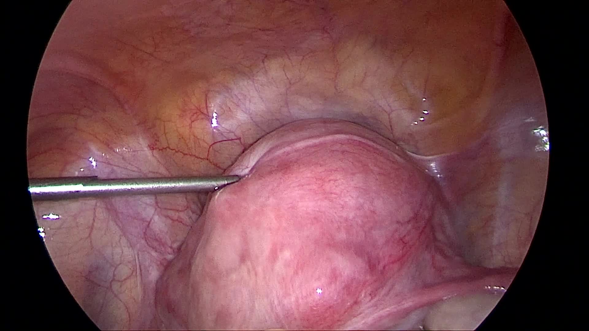 腹腔镜下子宫峡部肌瘤剔除术 妇产专业讨论版 丁香园论坛