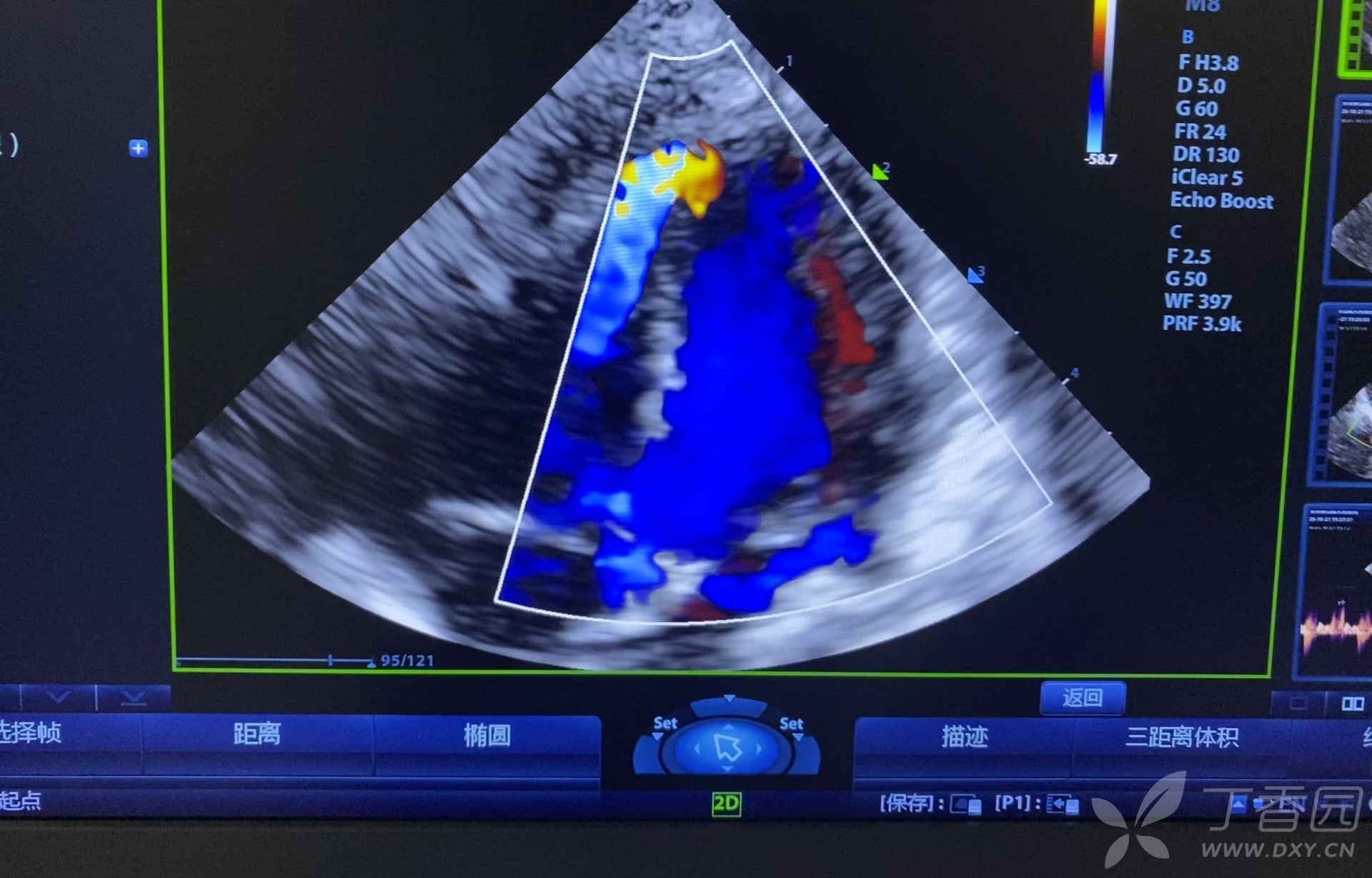 一例室间隔缺损怎么分型肌部