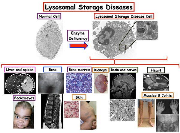 遗传性疾病——溶酶体贮积病的生物标志物