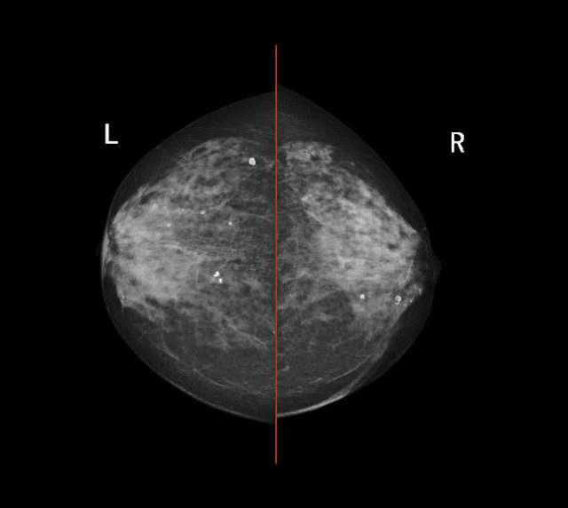 乳腺钼靶机在点压摄影检查中的应用