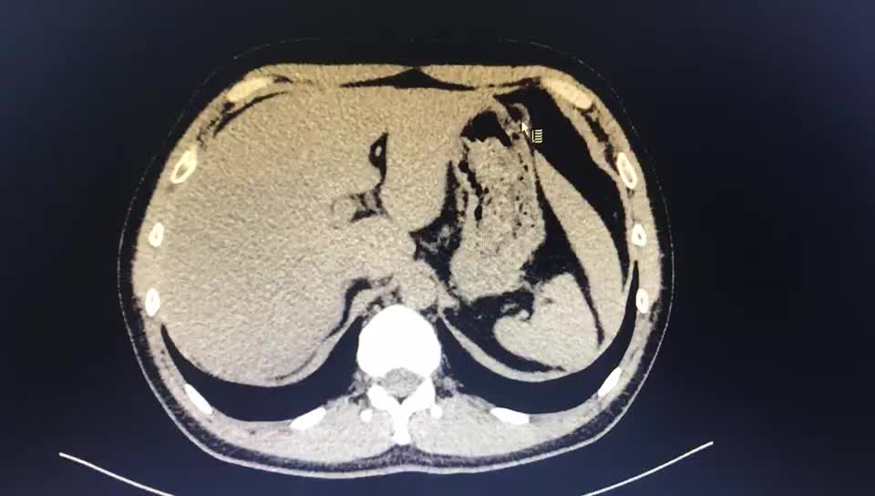 多发结肠憩室 [病例帖]