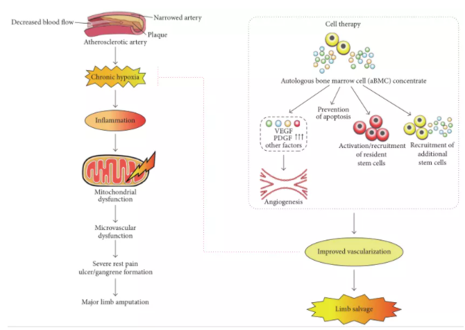 行业| 重症下肢缺血尚无治愈药物 细胞疗法或填补缺口