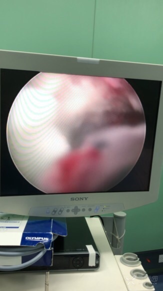 老年宫腔积脓 - 妇产专业讨论版 -丁香园论坛