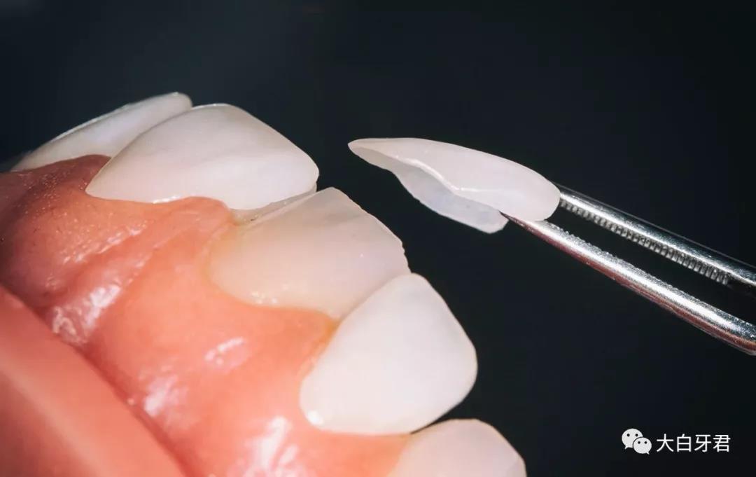 将加工厂制作完成的瓷贴面严密贴合在之前预备的牙齿上,确认和最初的