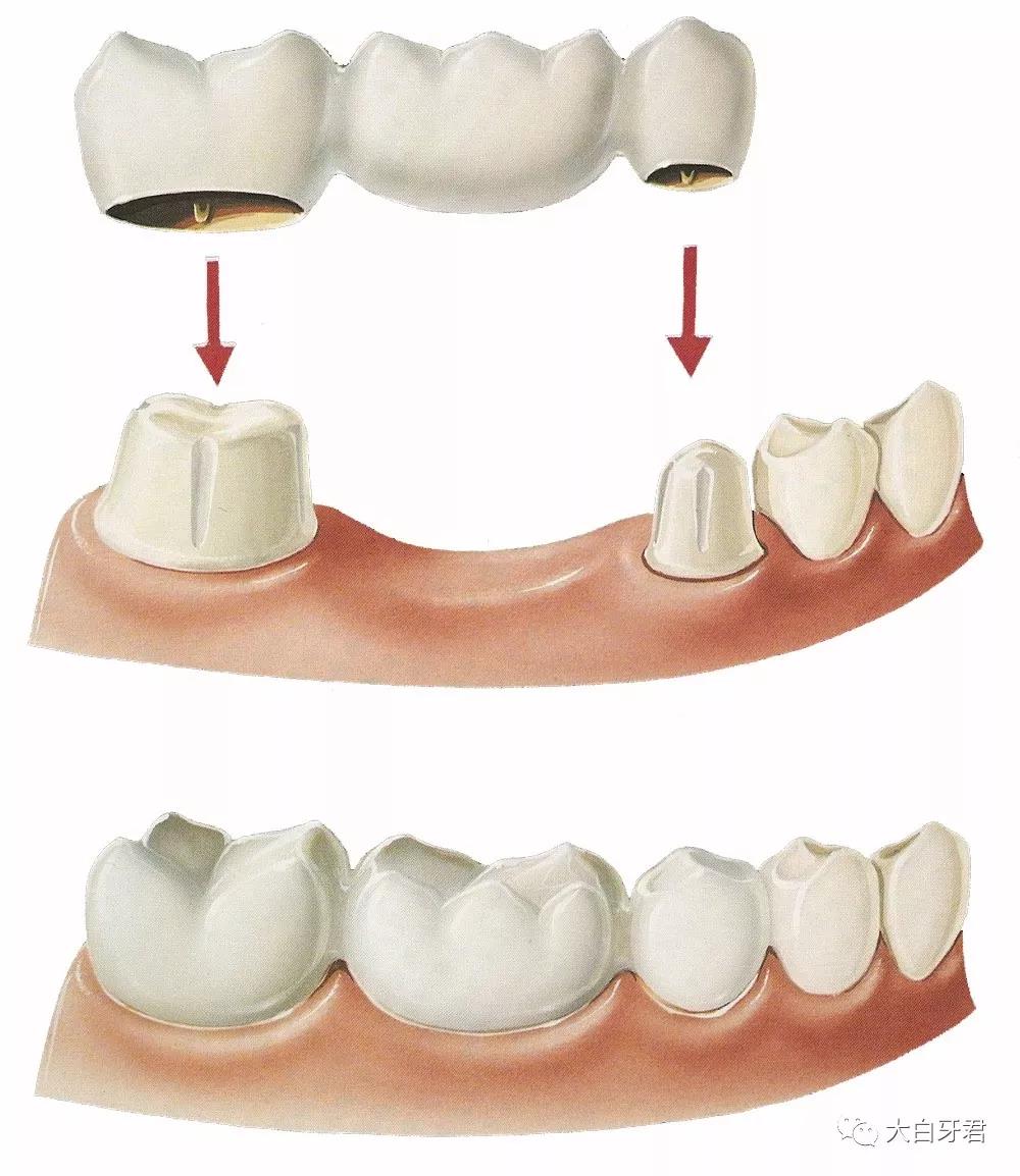 缺一个牙,利用两侧天然牙「搭桥」