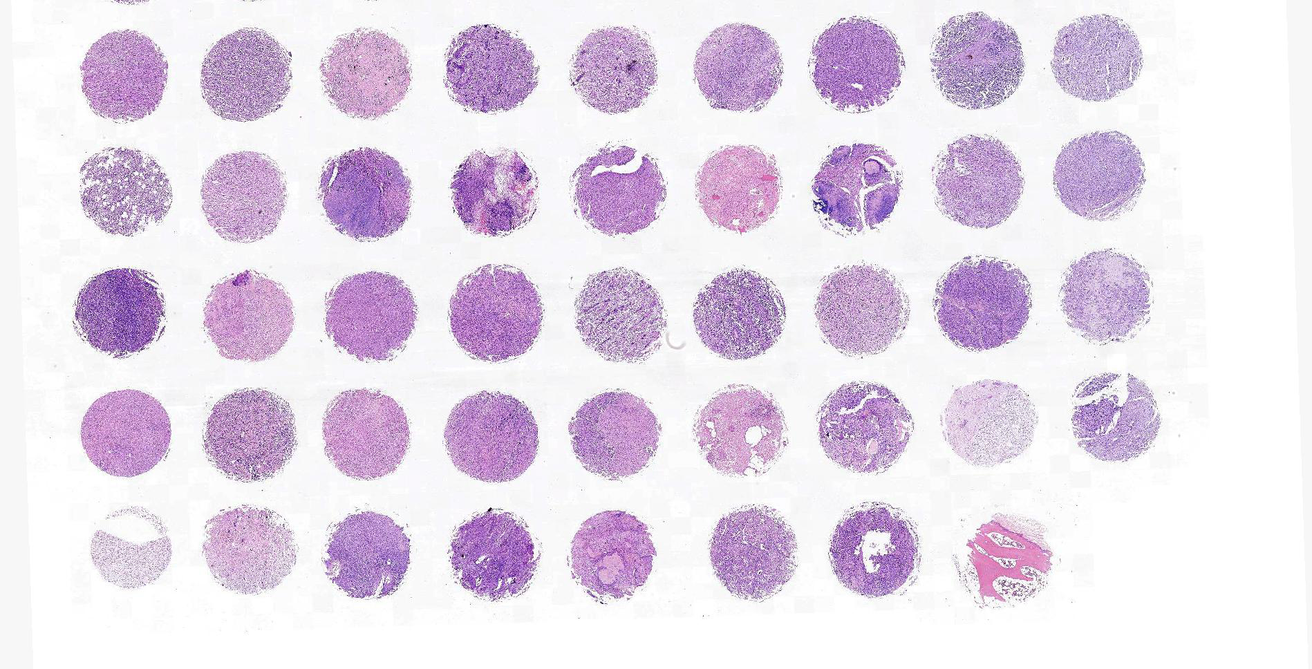 骨肉瘤组织芯片制作技巧及心得体会