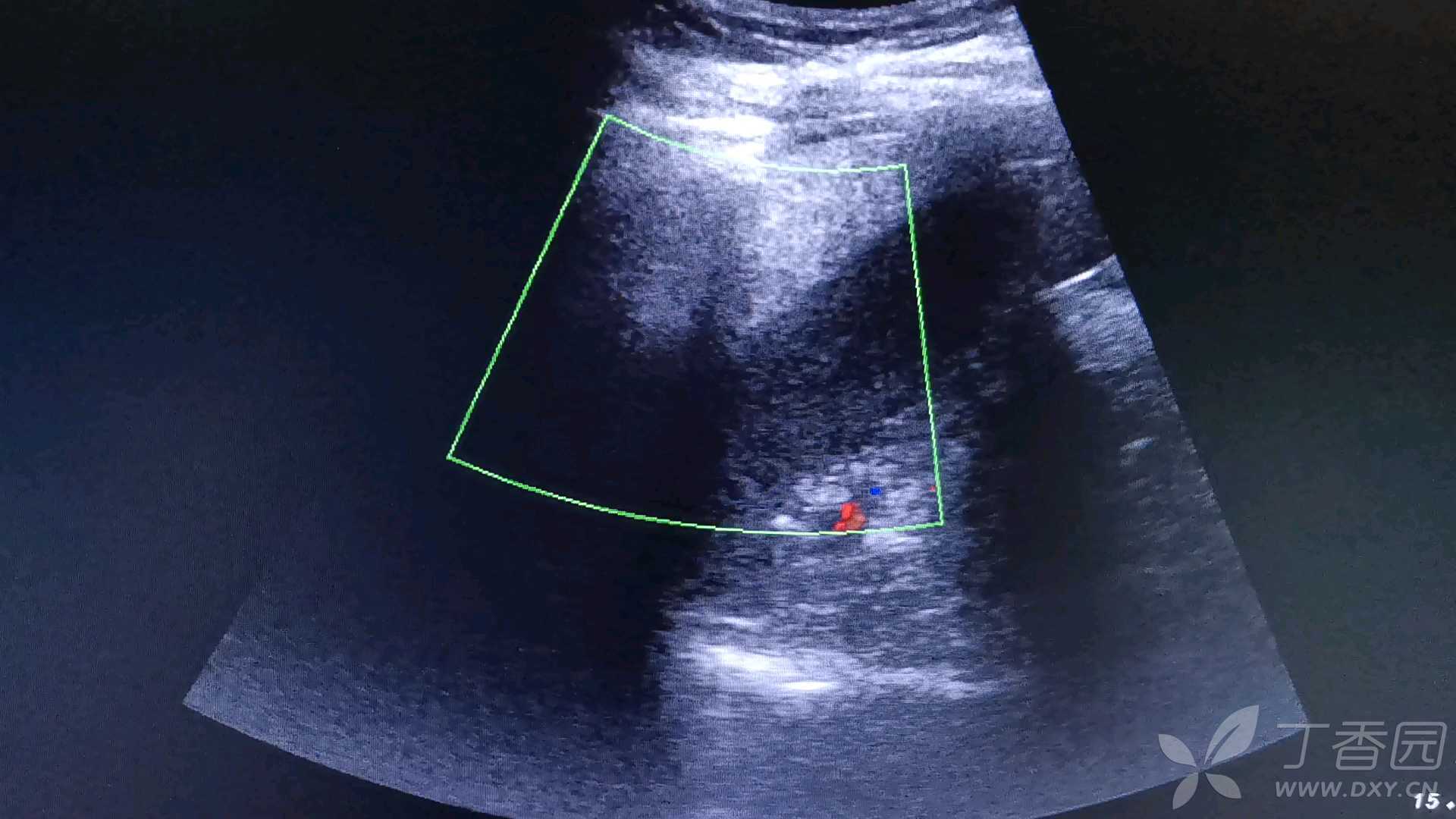 獭尾肝和正常肝图片图片
