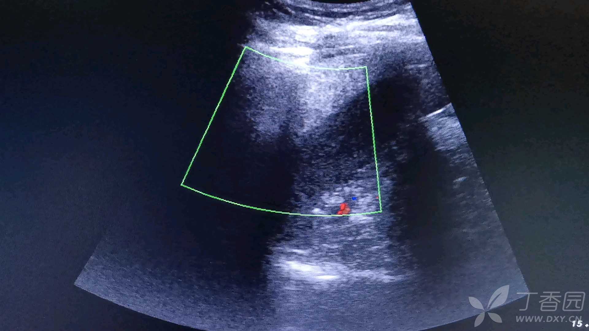 獭尾肝超声图片