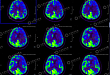 PET/CT 双期相扫描在烟雾病诊断中的应用