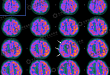 18F-FDG PET/CT 在癫痫病灶定位中的应用