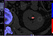 双源 CT 在泌尿系统结石分析中的应用