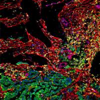 人肿瘤浸润白细胞（CD4+CD8+ T cell) 表型分析