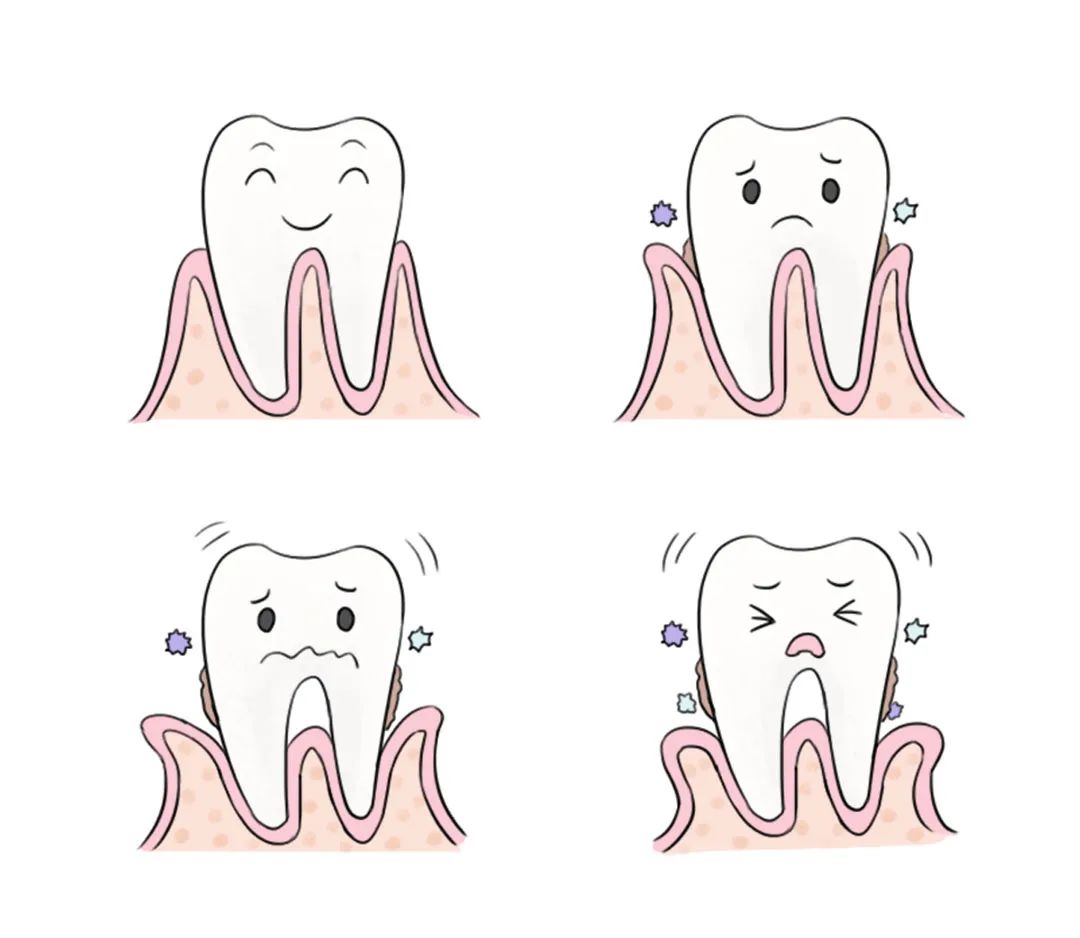 时间长了牙龈会萎缩,牙周组织被破坏,变成难治还烧钱的「牙周炎.