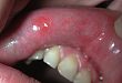 口腔二期梅毒，易被忽视的部位