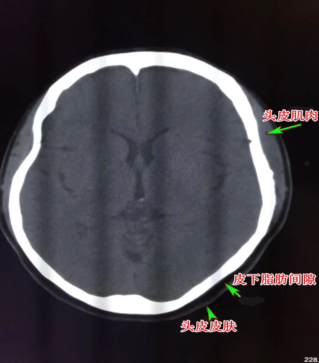 颅脑 CT 读片 纯干货 - 影像核医学 -丁香园论坛