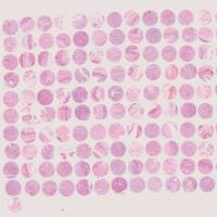 生存期食管癌组织芯片