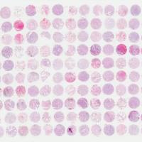 生存期肺腺癌组织芯片