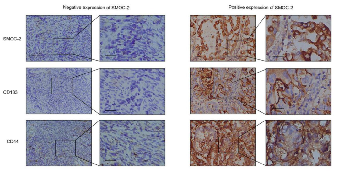 肿瘤干细胞研究套路:Wnt信号通路的激活